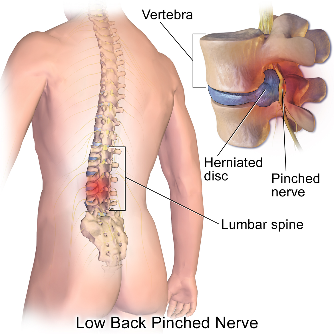 Common Running Injuries - Low Back Pain