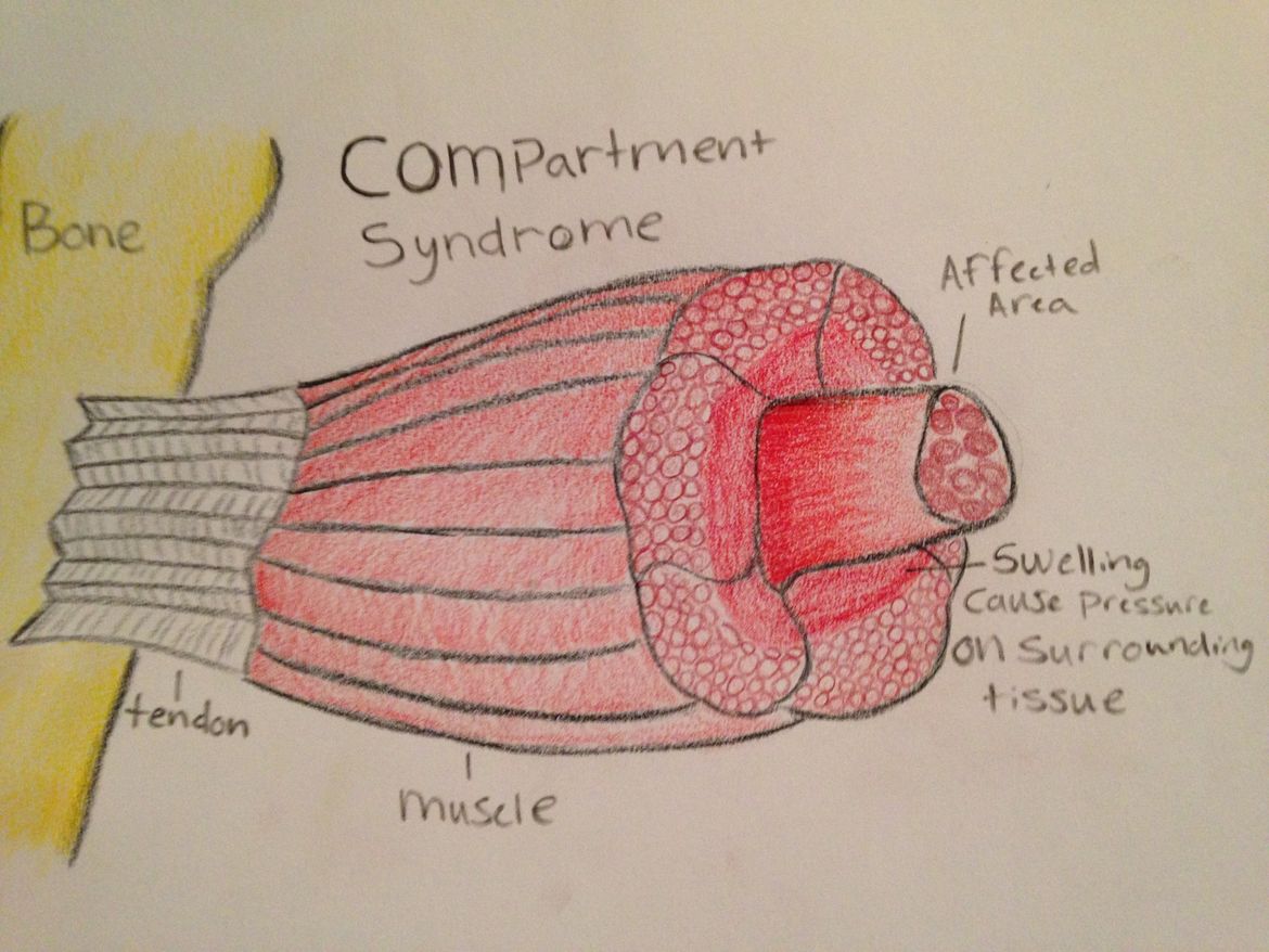 Common Running Injuries: Compartment Syndrome