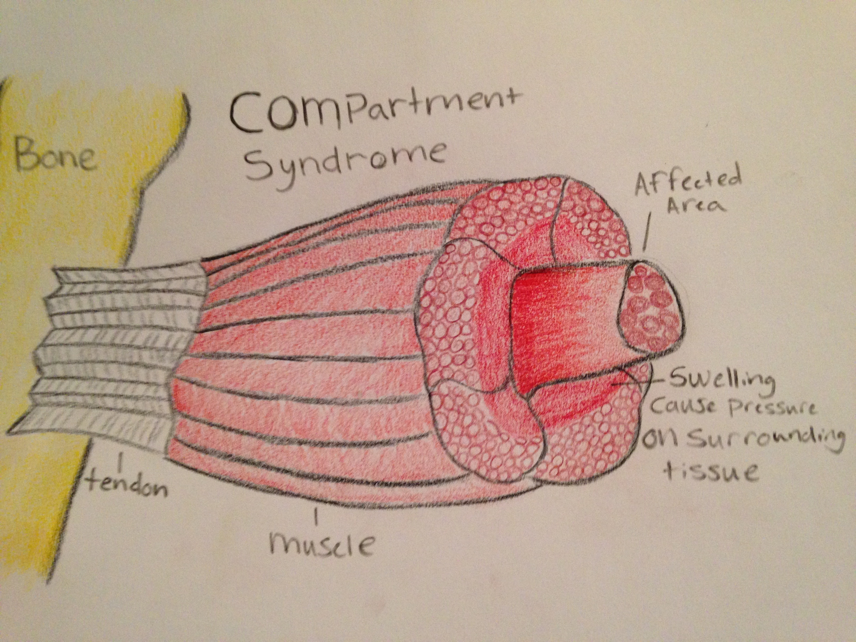 Common Running Injuries: Compartment Syndrome